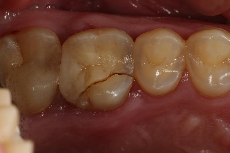 牙齿矫正后牙齿出现裂纹是何原因？-图1