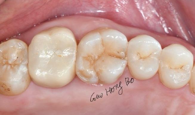 牙齿矫正后牙齿出现裂纹是何原因？-图3