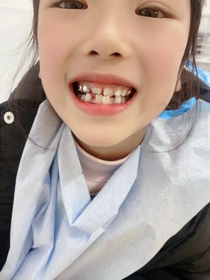 牙齿矫正钢丝脱离是什么原因?如何正确处理?-图2 牙齿矫正钢丝脱离是什么原因?如何正确处理?-图2