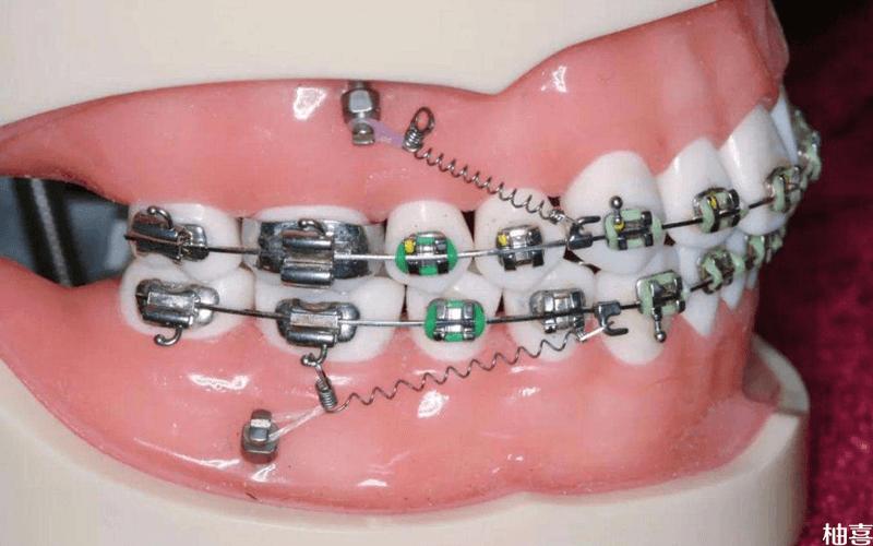 如何通过矫正有效提高牙齿高度?-图3 如何通过矫正有效提高牙齿高度?-图3