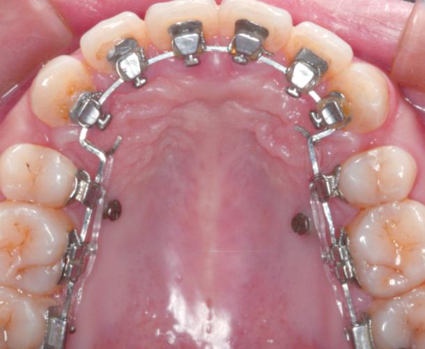 矫正牙齿内侧托槽是什么？与外侧托槽有何区别？-图2