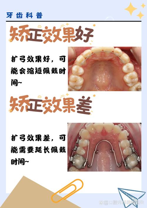 矫正牙齿排齐需要多久?-图1 矫正牙齿排齐需要多久?-图1