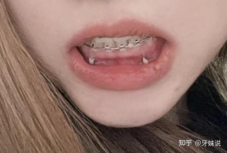 牙齿矫正后牙齿痛，正常吗？需如何缓解？-图2