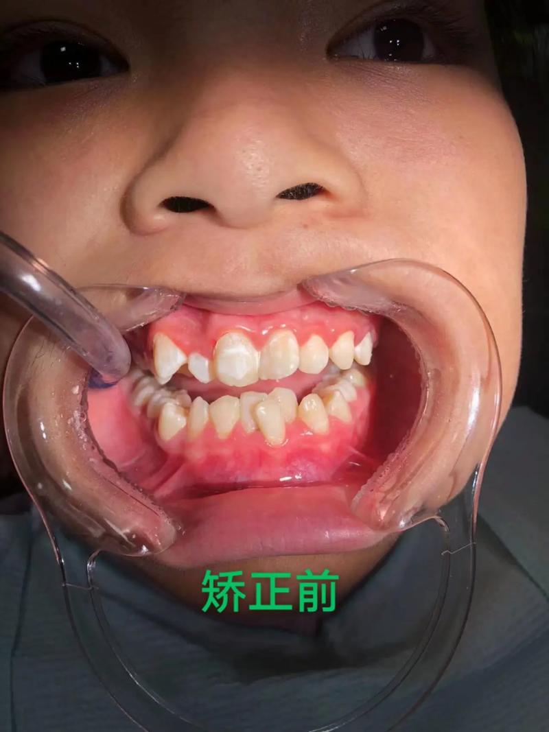 矫正牙齿后牙齿变弯?背后原因究竟是什么?-图1 矫正牙齿后牙齿变弯?背后原因究竟是什么?-图1