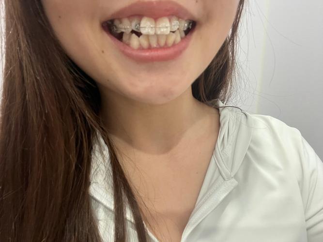矫正牙齿后牙齿变弯?背后原因究竟是什么?-图2 矫正牙齿后牙齿变弯?背后原因究竟是什么?-图2
