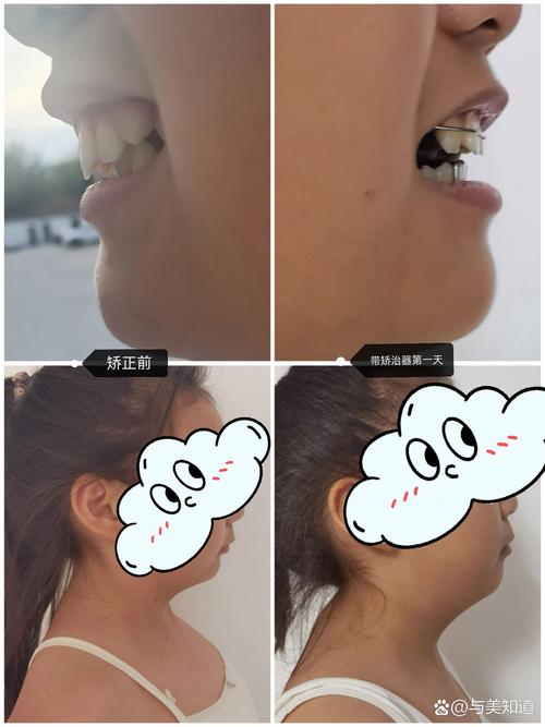 牙齿矫正Sgtb-图2