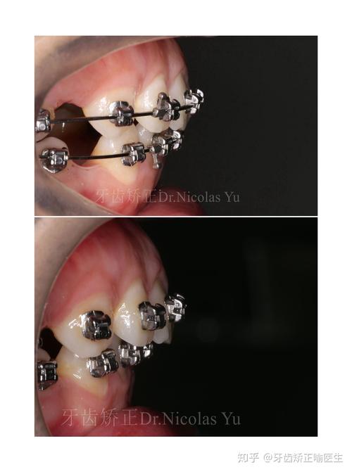 牙齿双颌前突矫正-图1