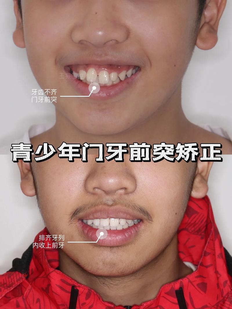 牙齿双颌前突矫正-图3