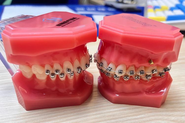 irok牙齿矫正-图3 irok牙齿矫正-图3