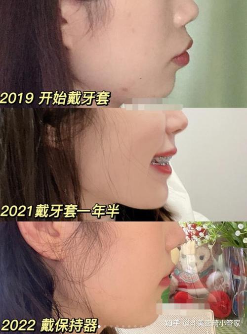 贵阳牙齿矫正怎么样？价格效果机构如何选？-图3