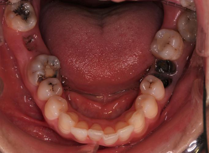 广州牙齿矫正效果怎样?价格贵不贵?-图3 广州牙齿矫正效果怎样?价格贵不贵?-图3