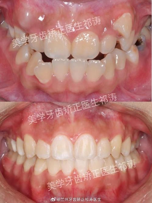 矫正下面一排牙齿效果如何？-图1
