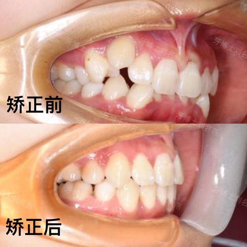 牙齿矫正拨牙1棵-图3