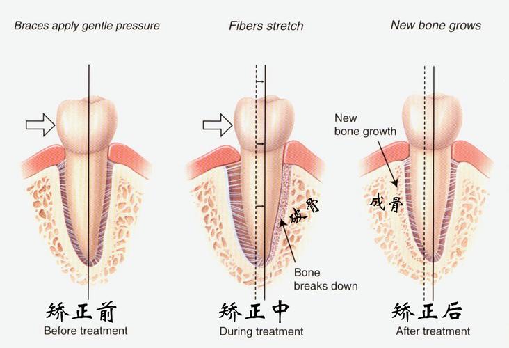 牙齿矫正上下移动-图2 牙齿矫正上下移动-图2