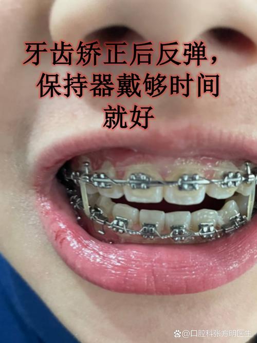 矫正牙齿反弹大吗-图2 矫正牙齿反弹大吗-图2