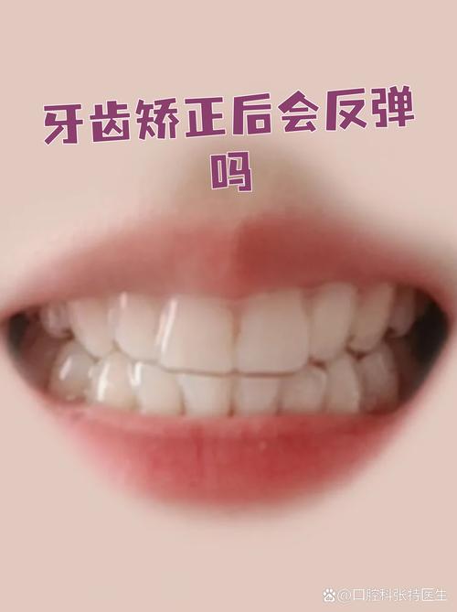 矫正牙齿反弹大吗-图3 矫正牙齿反弹大吗-图3