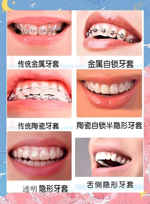 苏州陶瓷牙齿矫正-图2 苏州陶瓷牙齿矫正-图2