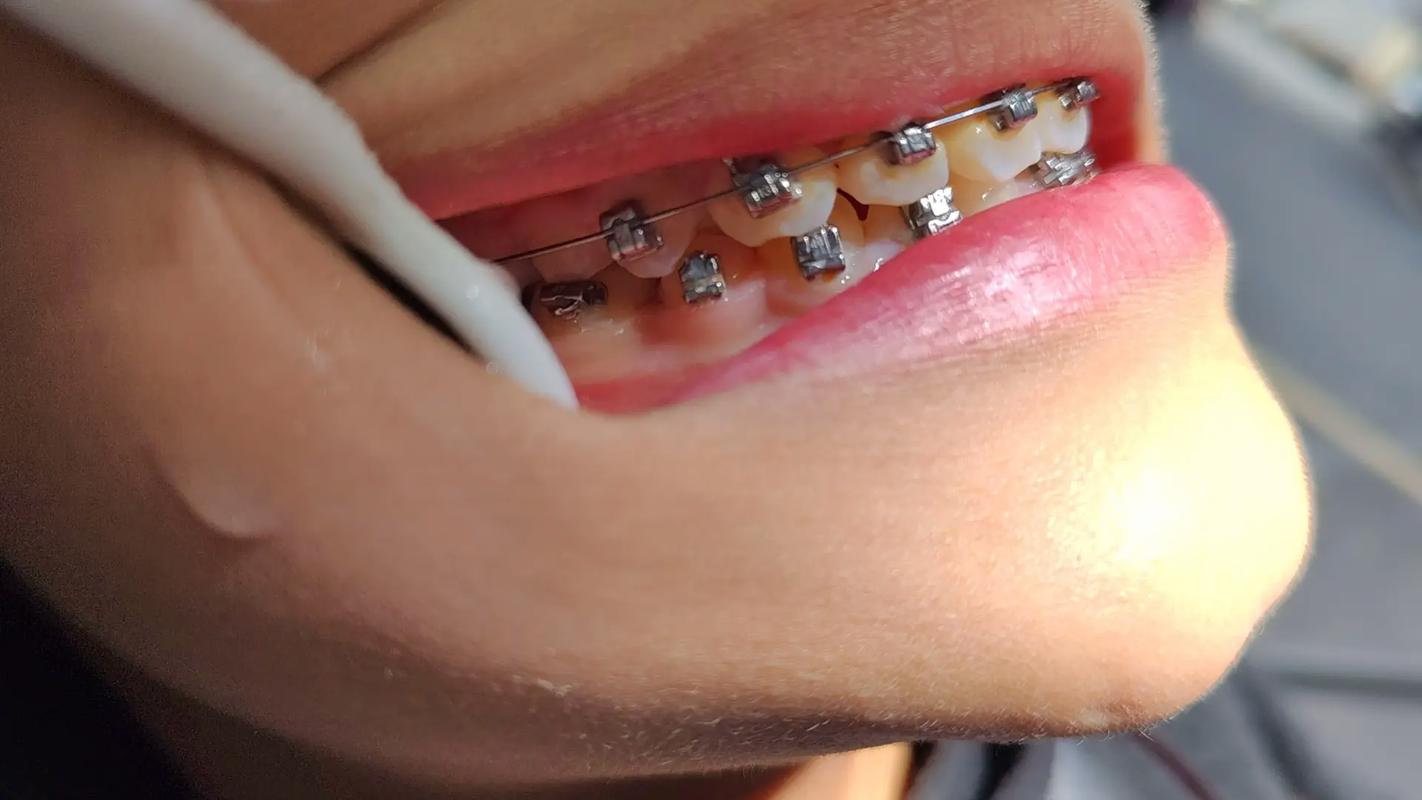 杭州牙齿矫正哪家好?如何选到靠谱的矫正机构?-图2 杭州牙齿矫正哪家好?如何选到靠谱的矫正机构?-图2