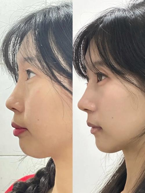 牙齿矫正后为何会大小脸?如何改善与预防?-图2 牙齿矫正后为何会大小脸?如何改善与预防?-图2