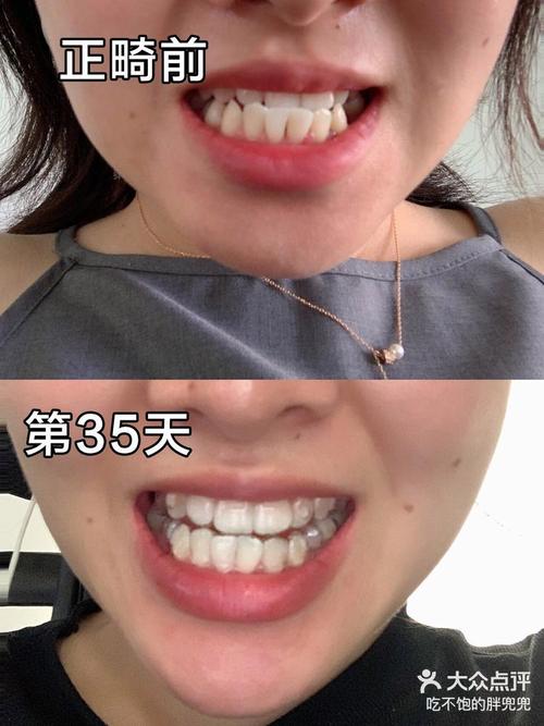 牙齿矫正后为何会大小脸?如何改善与预防?-图3 牙齿矫正后为何会大小脸?如何改善与预防?-图3