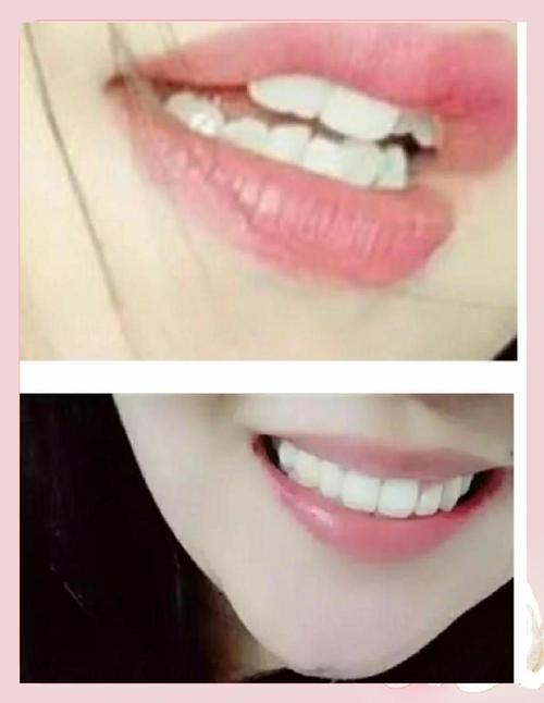 27岁女牙齿矫正-图1