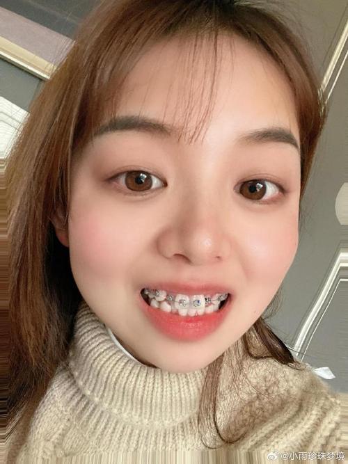 27岁女牙齿矫正-图2