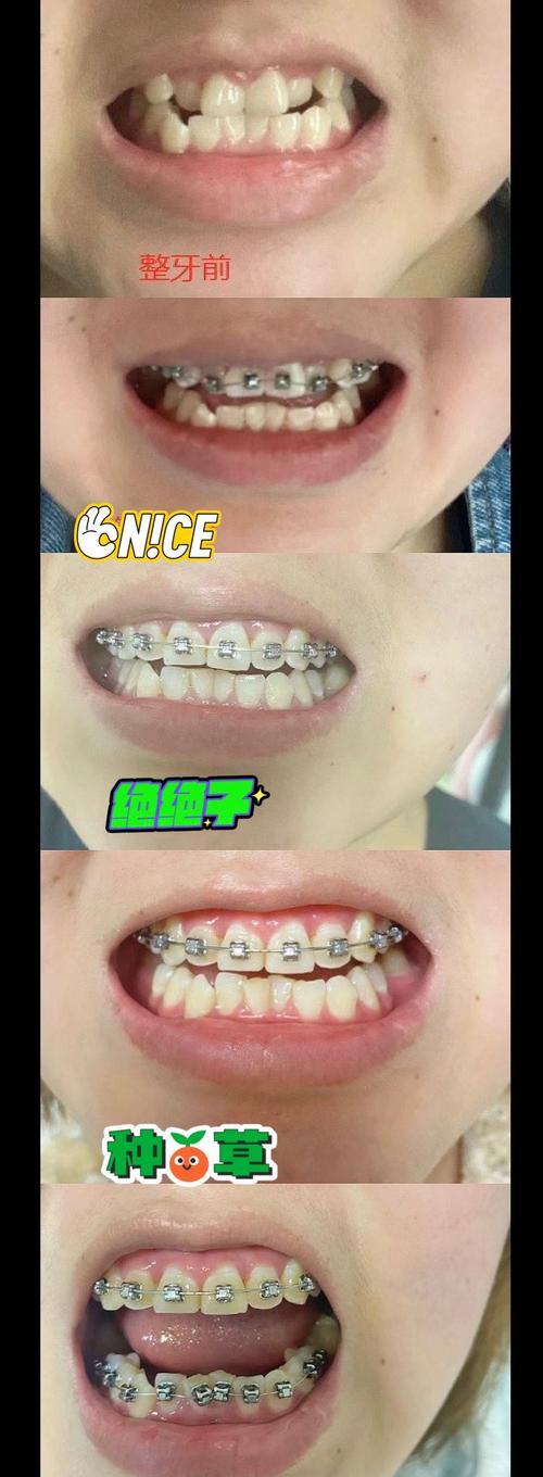 东莞虎门牙齿矫正-图2