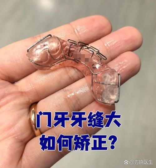 矫正牙齿一定要拔门牙吗？专家解析拔门牙矫正的注意事项-图3