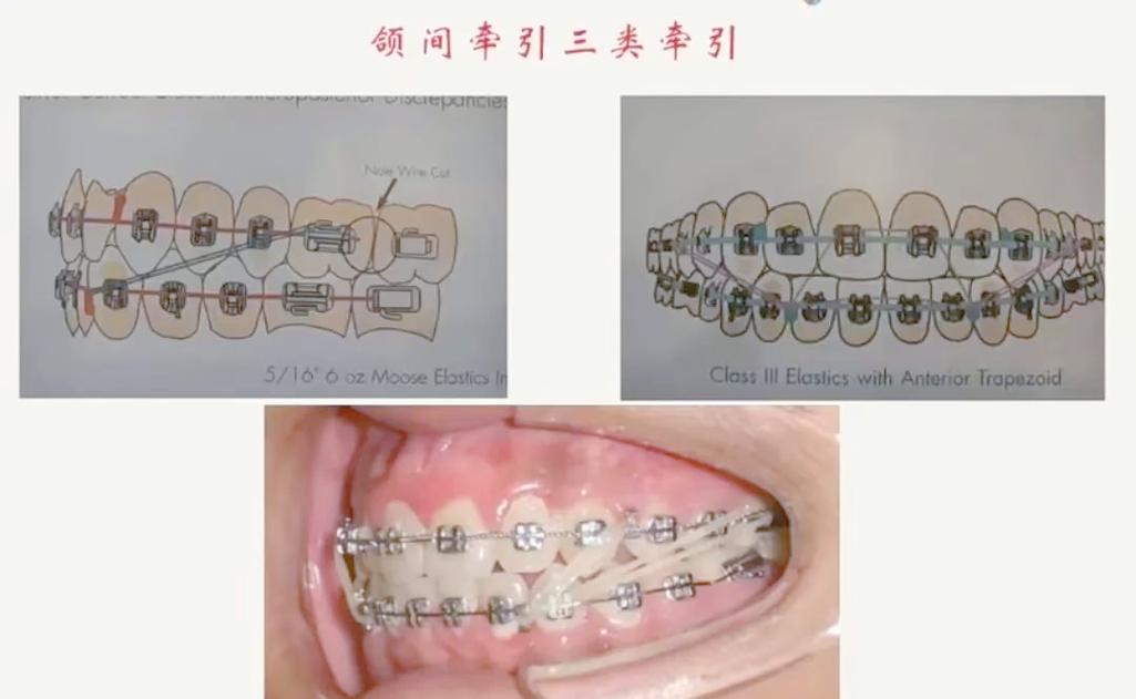 牙齿矫正为何需要精细调整?这阶段要注意哪些细节?-图2 牙齿矫正为何需要精细调整?这阶段要注意哪些细节?-图2