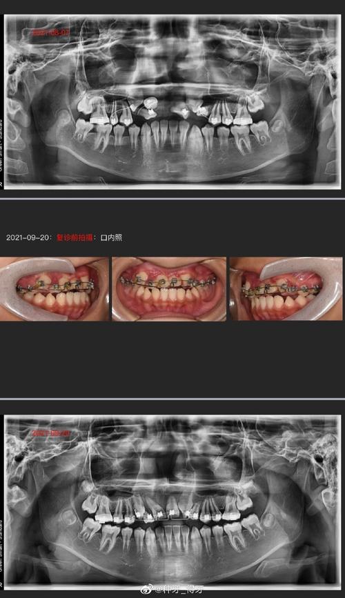 矫正牙齿没有拍片-图2