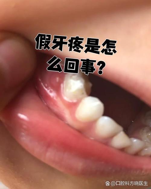 矫正牙齿期间牙疼，是正常现象吗？怎么缓解才好？-图3