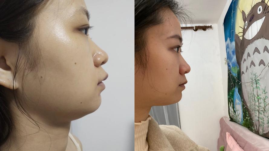 龅牙矫正前后牙齿和脸型变化有多大?效果真的值吗?-图1 龅牙矫正前后牙齿和脸型变化有多大?效果真的值吗?-图1