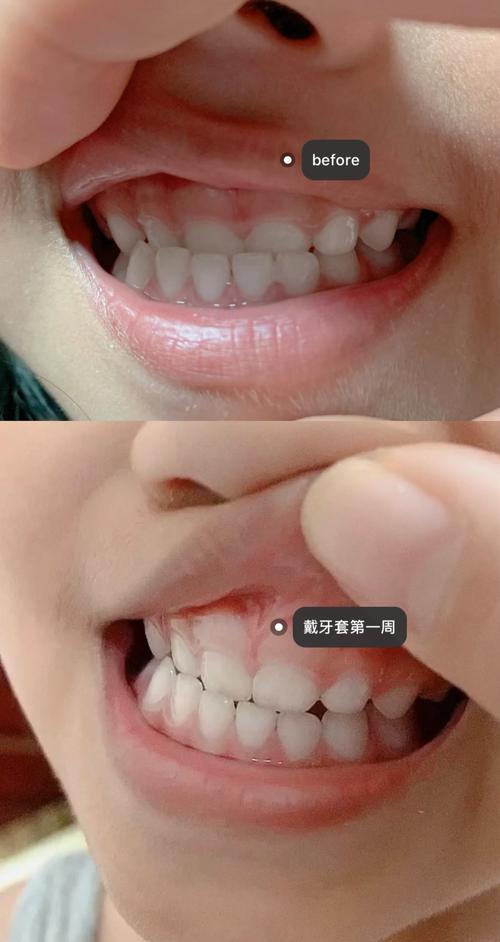 牙齿矫正地包天，最佳矫正时机是几岁？-图3