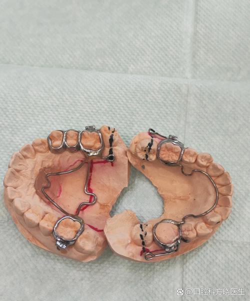 矫正大牙时为何要固定？关键作用与注意事项有哪些？-图1