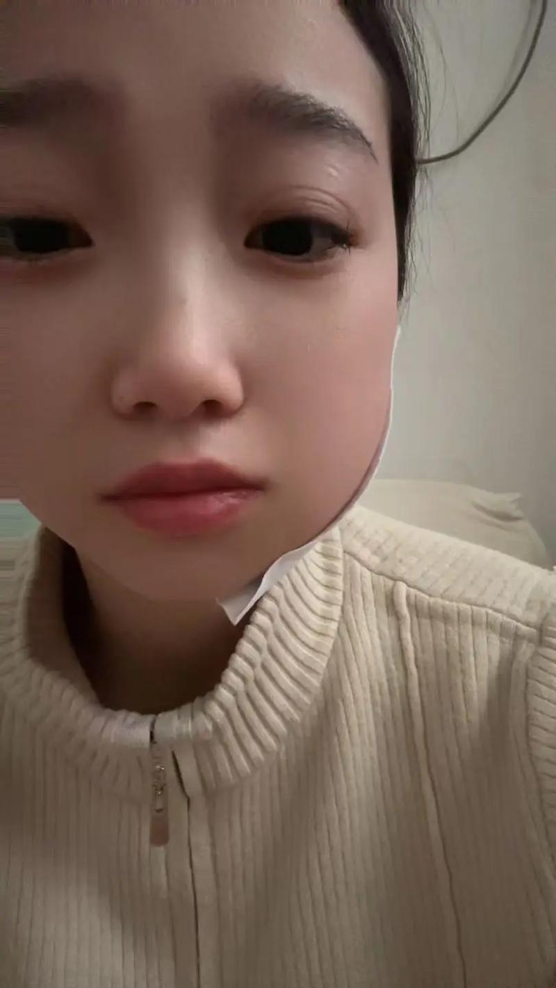 矫正牙齿拔牙后脸肿是正常现象吗？-图2