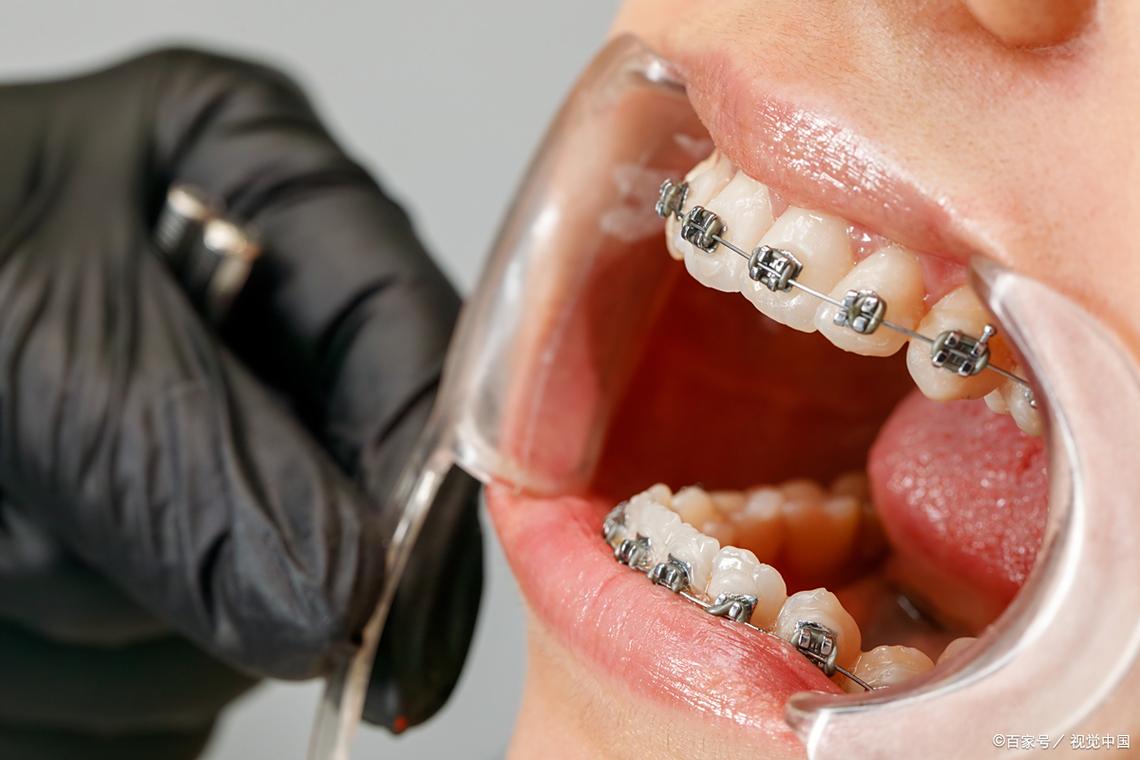 牙齿矫正加力视频-图2