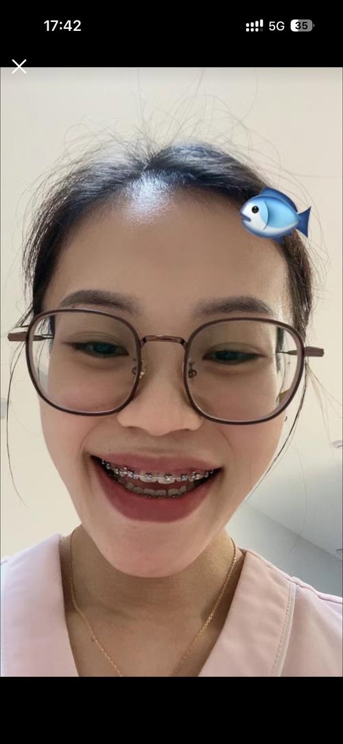 牙齿矫正 33岁-图1