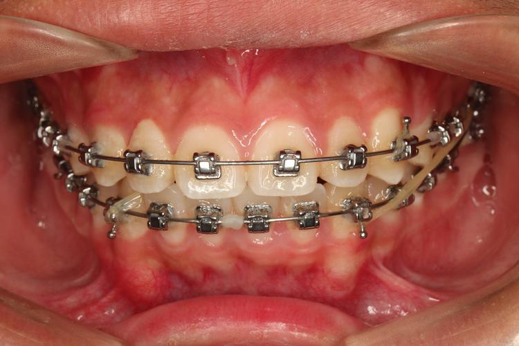 佩戴牙齿矫正器吗-图2 佩戴牙齿矫正器吗-图2