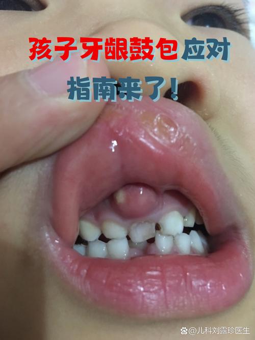 牙齿矫正后牙龈肿-图2 牙齿矫正后牙龈肿-图2