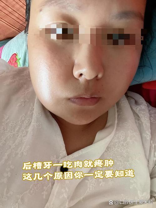 牙齿矫正后牙龈肿-图1 牙齿矫正后牙龈肿-图1