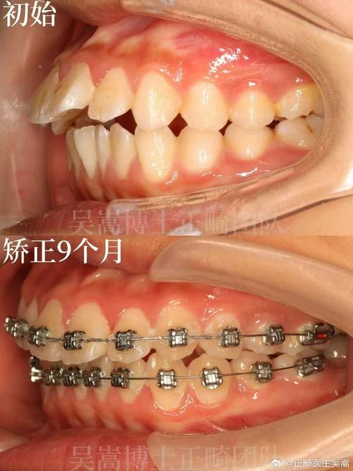门牙前凸矫正,如何选择适合自己的矫正方法以达到最佳效果?-图3 门牙前凸矫正,如何选择适合自己的矫正方法以达到最佳效果?-图3