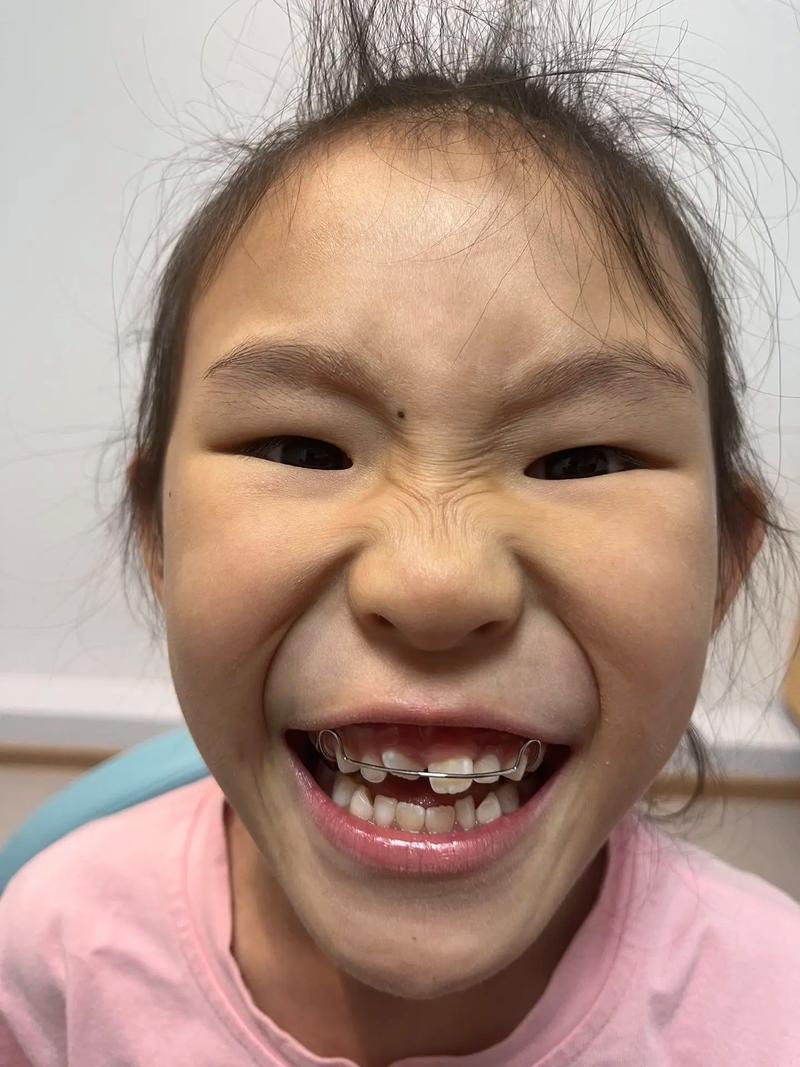 一小时矫正牙齿可行吗？效果安全吗？-图2