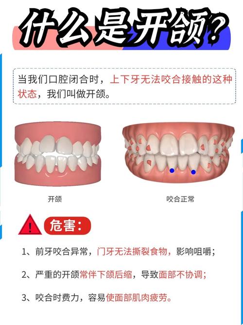 牙齿开颌能矫正吗?-图1 牙齿开颌能矫正吗?-图1