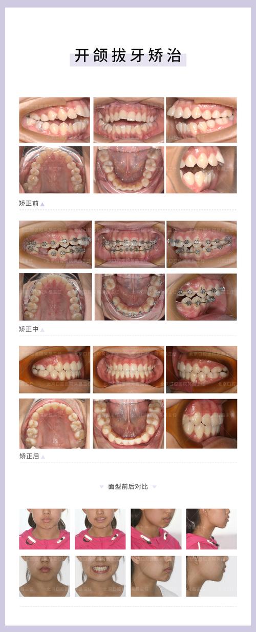牙齿开颌能矫正吗?-图2 牙齿开颌能矫正吗?-图2