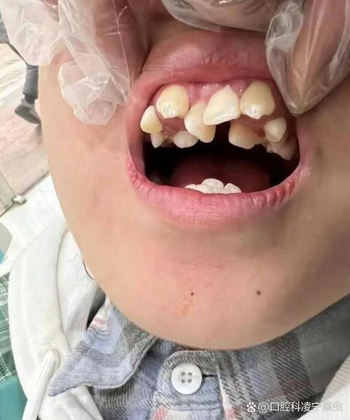 矫正牙齿过程中牙齿越来越歪，到底是什么原因导致的？-图1