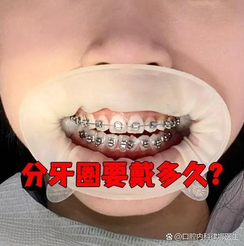 矫正牙齿用分牙吗-图2