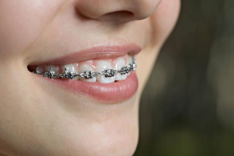 矫正牙齿用分牙吗-图3