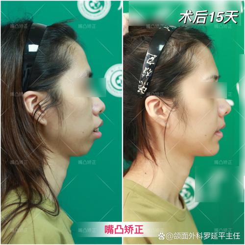 嘴凸矫正前后对比图片真实吗?-图1 嘴凸矫正前后对比图片真实吗?-图1