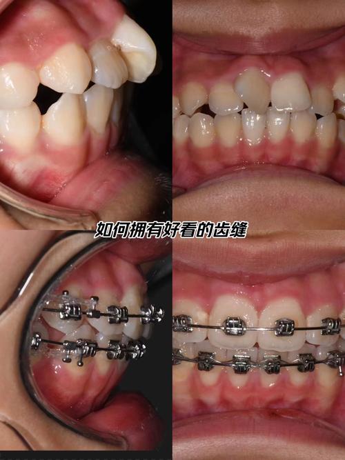 嘴凸矫正前后对比图片真实吗?-图3 嘴凸矫正前后对比图片真实吗?-图3