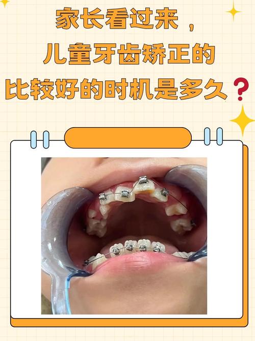 小孩牙齿矫正痛吗?家长必知的疼痛解答与缓解指南-图1 小孩牙齿矫正痛吗?家长必知的疼痛解答与缓解指南-图1